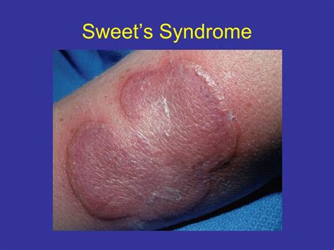 ppt sweet s syndrome powerpoint presentation free download id 6015788