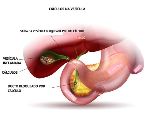Pedra Na Vesicula Altera O Tgo E Tgp