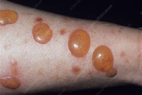 Blisters After Liquid Nitrogen Treatment Stock Image M7280034