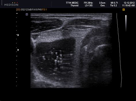Vietnamese Medic Ultrasound Case Thyroid Cyst With Comet Tail
