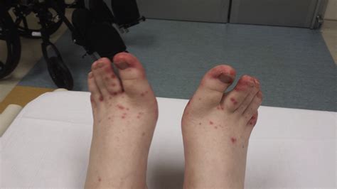 Child With Purpuric Rash On Feet Journal Of Emergency Medicine