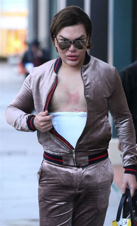 Human Ken Doll Rodrigo Alves Gets Four Ribs Removed In Stomach