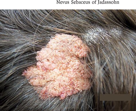 Figure 1 From Images In Clinical Medicine Nevus Sebaceus Of Jadassohn