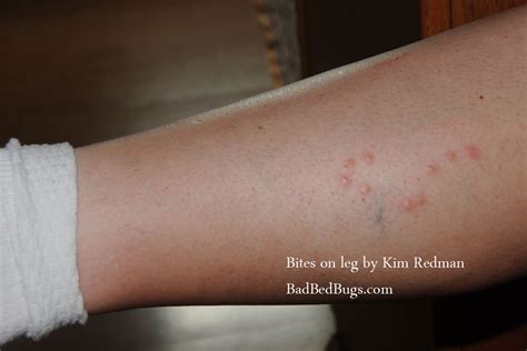 What Do Bed Bugs Bites Look Like Like This