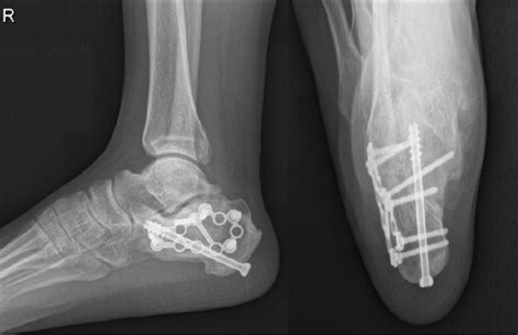 The Lateral And Axial Views Of Calcaneus Postoperatively Showing The