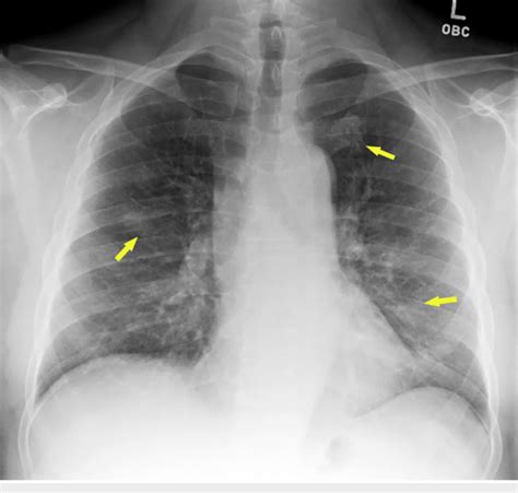 Chest X Ray Showing Hazy Bilateral Lung Opacities Arrows Download