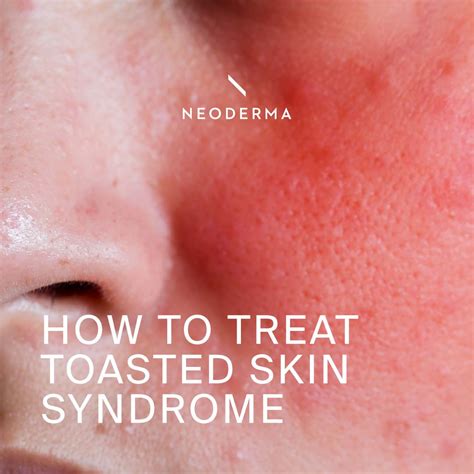 How To Treat Toasted Skin Syndrome Neoderma