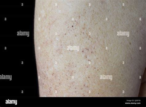 Age Spots And White Patches On Arm Of Asian Elder Man Age Spots Are
