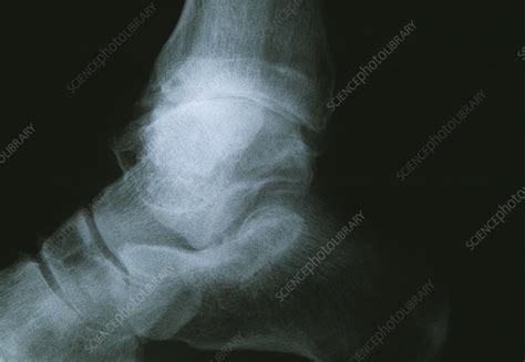 Osteoarthritis Of The Ankle X Ray Stock Image M1100524 Science