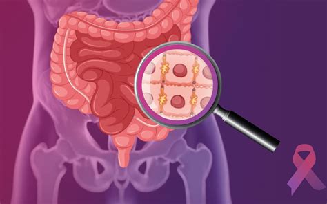 Colorectal Cancer And Treatment Curia App