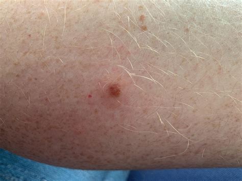 Ive Had This Mole Forever Today It Is Itchy And Its Raised A Little
