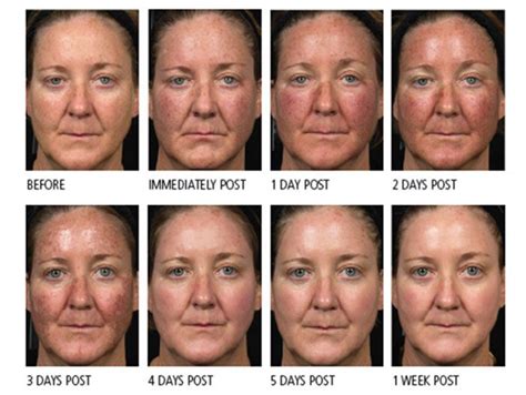 Best Effective Way To Treat Skin Discoloration Laser