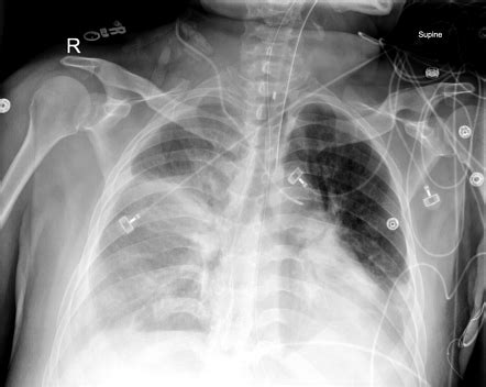 Malpositioned Right Internal Jugular Vein Catheter Radiology Case