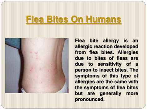 PPT Flea Bites On Humans PowerPoint Presentation ID