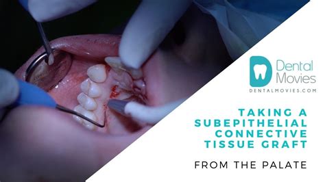 Taking A Subepithelial Connective Tissue Graft From The Palate Youtube