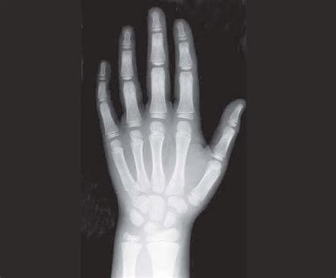Hand And Wrist Radiograph Showing Carpal Bones Download Scientific