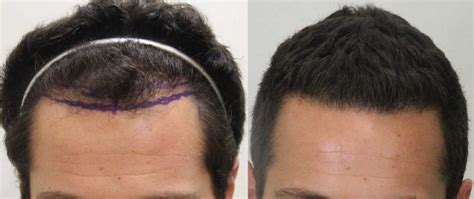 Aloe vera is also considered good for promoting hair growth. Picture of patient before & after Rahal FUE™
