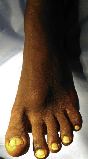 Unusual Presentation Of Foreign Body Granuloma Of The Foot