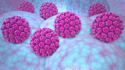 Human Papillomavirus Infection Virus Hpv Is The Most Common Sexually