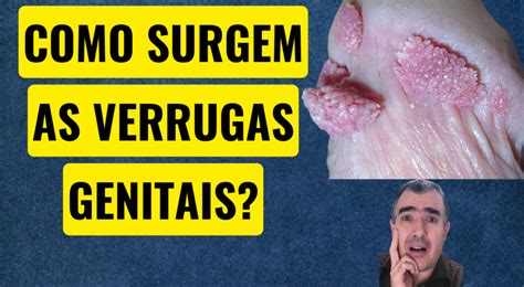 Vamos Saber Como Surgem As Verrugas Genitais Dr Lucas Felipe Gomes