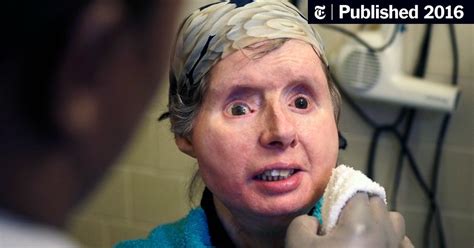 chimpanzee attack victim who got face transplant is hospitalized the new york times