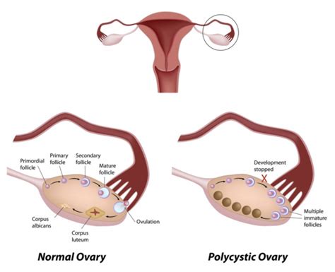 What Is Polycystic Ovary Syndrome Pcos And How It Can Cause