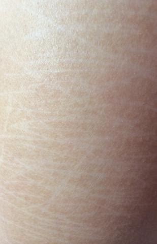 Zuerst gilt es narzissten als solche zu erkennen. Wie bekomme ich alte Narben weg? (Haut, Hautpflege, Creme)