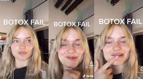 Woman Who Has Botox At 21 Panicking About Gills Due To Bulging In Her