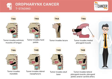 Oropharyngeal Throat Cancer Tnm Staging And Treatment