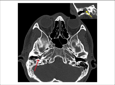 High Resolution Computed Tomography Hrct Temporal With Soft Tissue