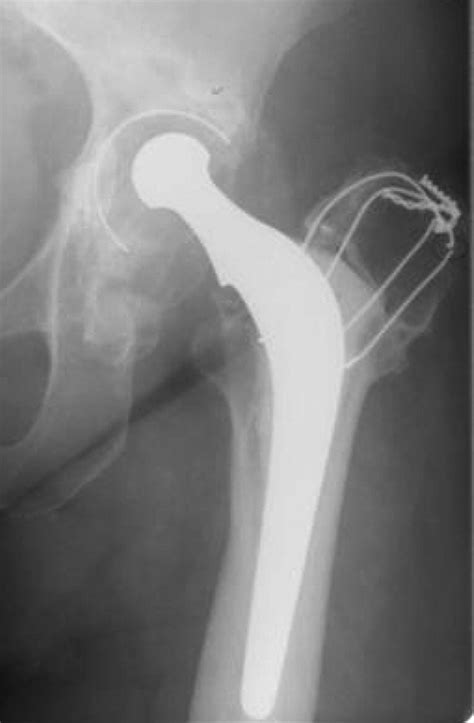 The Management Of Severe Acetabular Bone Defects In Revision Hip