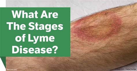 What Are The Stages Of Lyme Disease