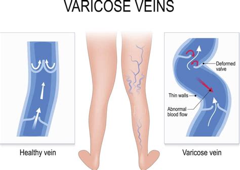 7 Key Differences Between Spider Veins And Varicose Veinsunlocking The