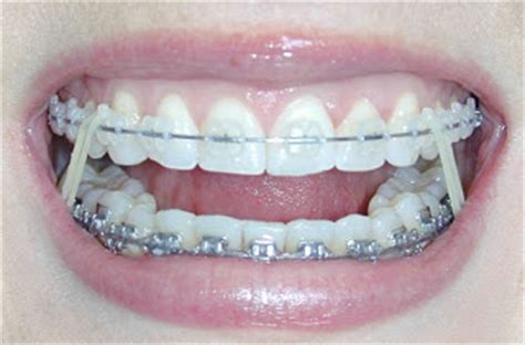 The number of hooks or buttons you have, and where they are found, depends on the position of your rubber bands. Bales Orthodontics: How do Rubber Bands Work with Braces?