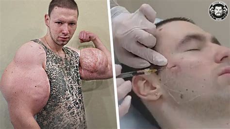 Russian ‘bodybuilder Popeye Gets Synthol Injected Into His Cheeks Youtube