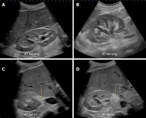 Point Of Care Renal Ultrasonography For The Busy Nephrologist A