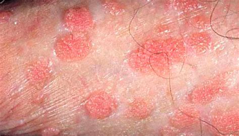 Genital Warts Summerlin Dermatolo­gy