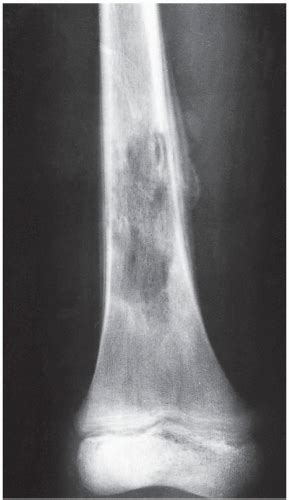 Osteomyelitis, Infectious Arthritis, and Soft-Tissue Infections