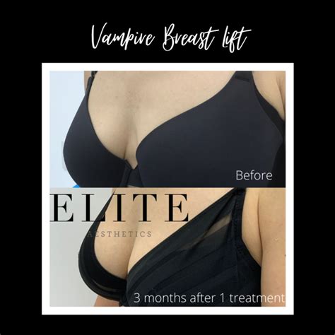 Vampire Breast Lift Perkier Cleavage Elite Aesthetics