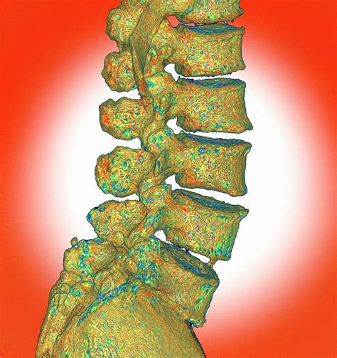 Lumbar Spine Degeneration Photograph By K H Fungscience Photo Library