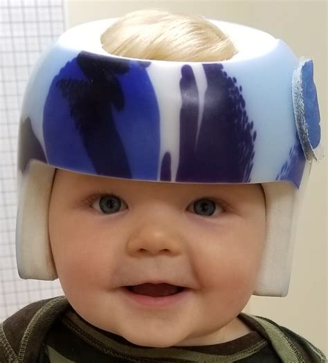 Cranial Remolding Helmets And Sleep Surfaces For Plagiocephaly