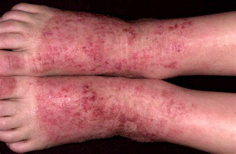 Clear fluid may come from the affected areas, which often thickens over time. Atopic Dermatitis Picture (Hardin MD Super Site Sample)