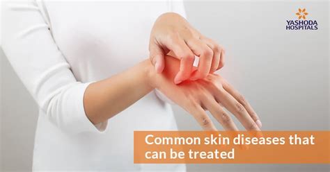 Skin Diseases Causes Symptoms Prevention And Treatment