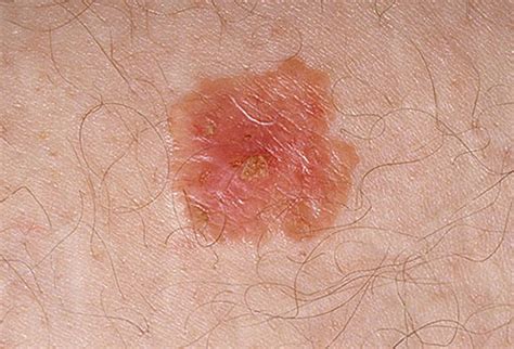 Many relate to a typical mole as darker than your general tone and red, black, or brown. Pictures of skin cancer: Pictures of skin cancer
