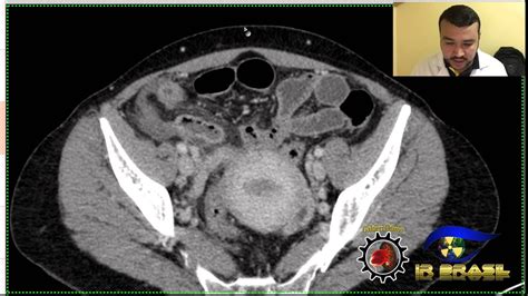 Exame Para Descobrir Apendicite