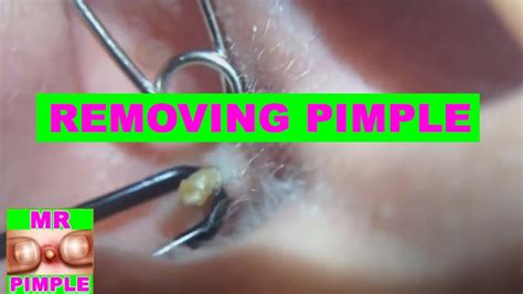 Removing Pimple Inside The Ear Mr Pimple Youtube