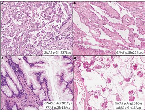 Gnas Mutated Lung Carcinoma Histology A Case 3 With Gnas