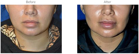 Buccal Fat Reduction In Newport Beach Faceologymd