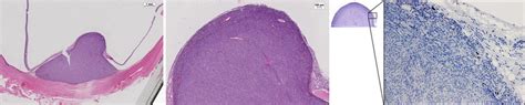 A Histopathology Of The Enucleated Eye On He Stain Confirming