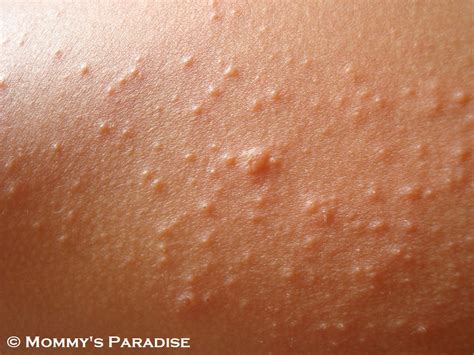 It leads to itchy or burning rash with bumps or blisters. skin rash under arms - pictures, photos